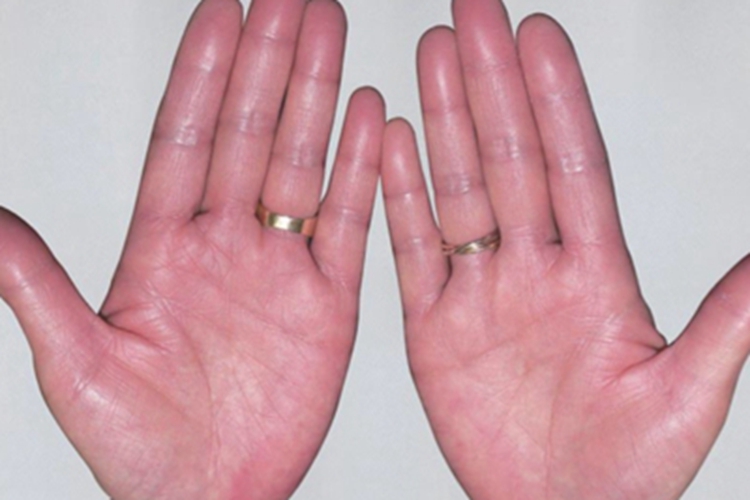 1级手足综合征手掌红斑图