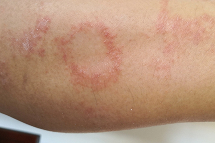 玫瑰糠疹肘部红斑图 玫瑰糠疹肘部红斑图