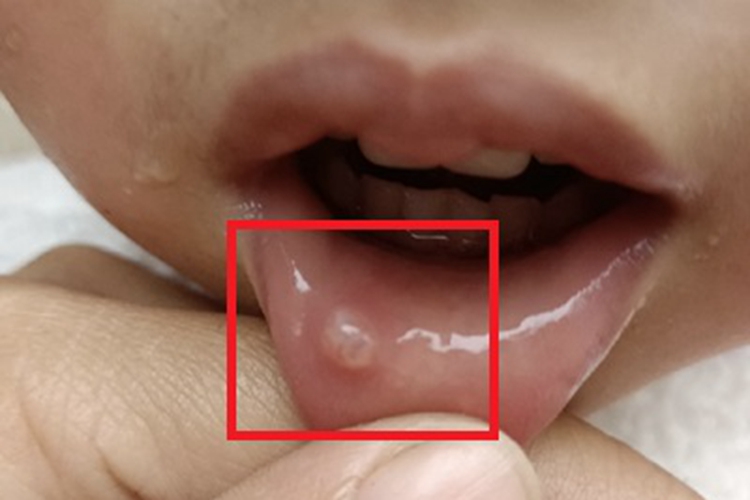 黏液腺囊肿唇内侧症状图