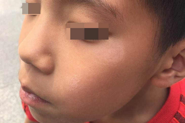 小孩白色糠疹眼角白斑症状图