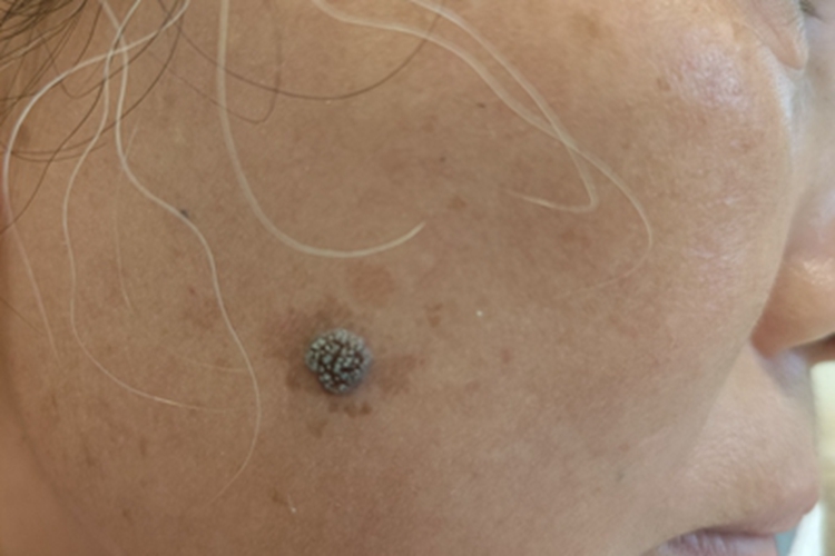 寻常疣面部症状图