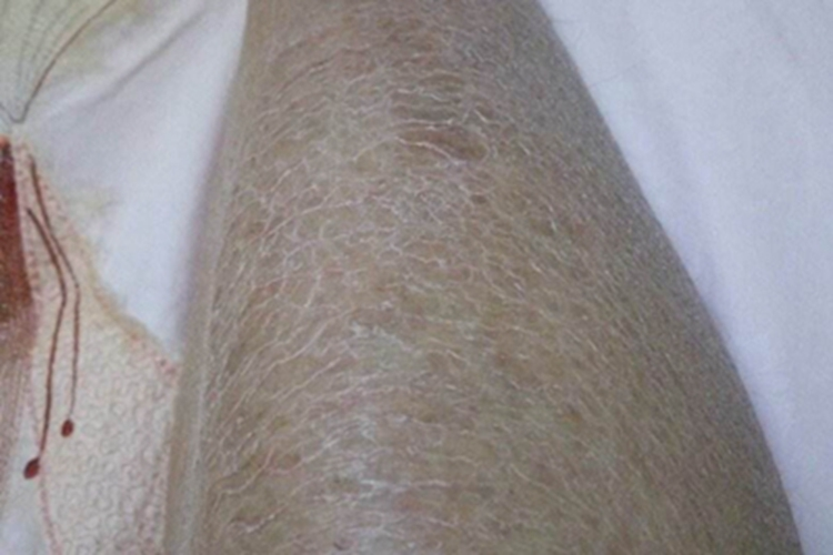 皮肤干燥症结痂图