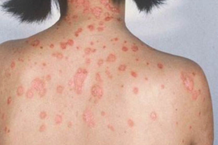 急性点滴型儿童银屑病背部红斑图