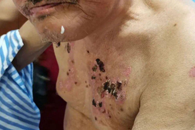 疱疹样天疱疮胸部黑痂图