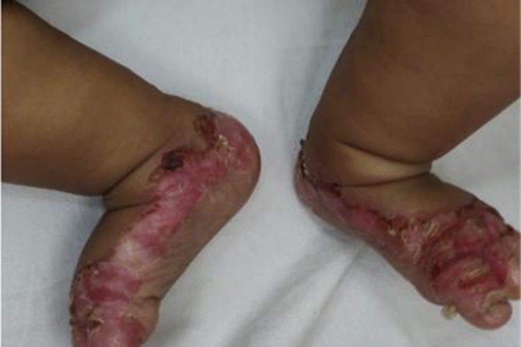 肠病性肢端皮炎脚部脱皮结痂图