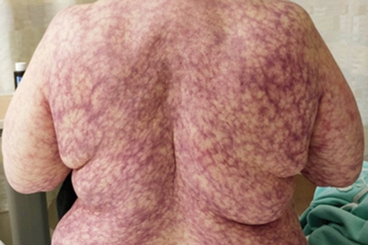 继发性网状青斑背部症状图 继发性网状青斑背部症状图