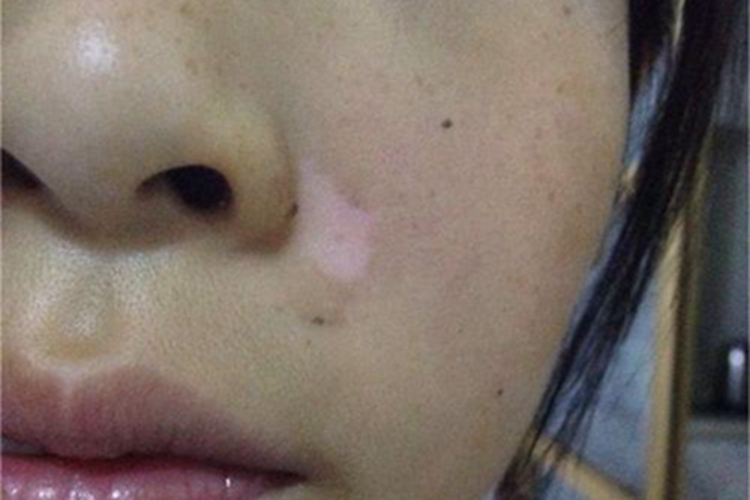 白癜风鼻翼白斑图 白癜风鼻翼白斑图