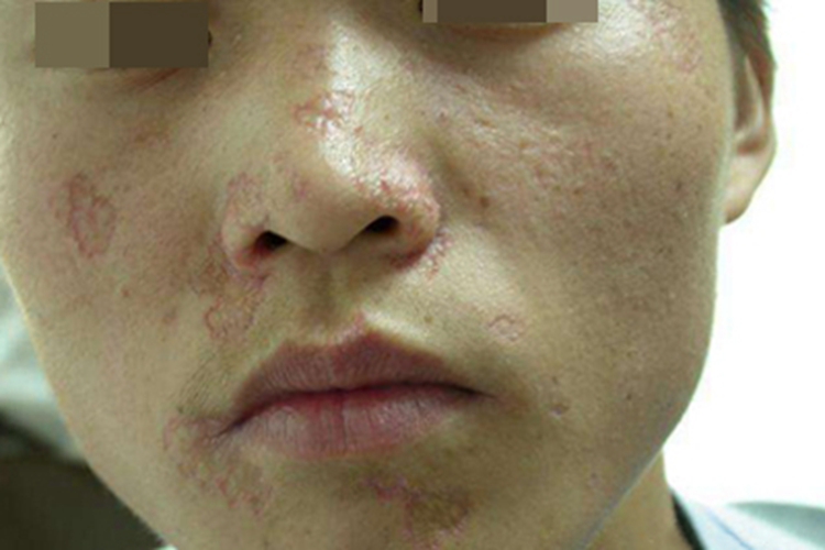 面部萎缩性毛周角化病瘢痕图