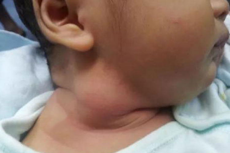 婴儿斜颈包块示意图