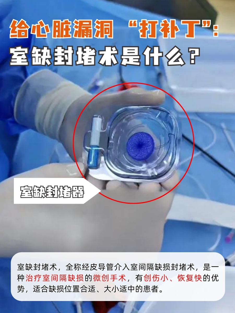 给心脏漏洞“打补丁”：室缺封堵术是什么？