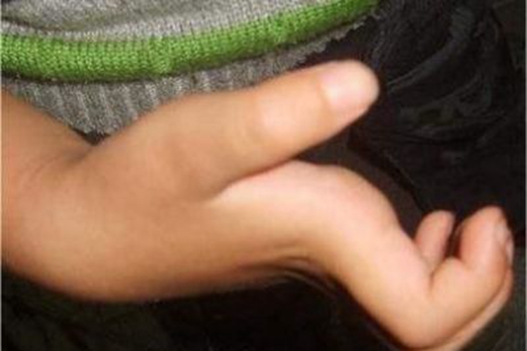 缺血性肌挛缩手部症状图 缺血性肌挛缩手部症状图