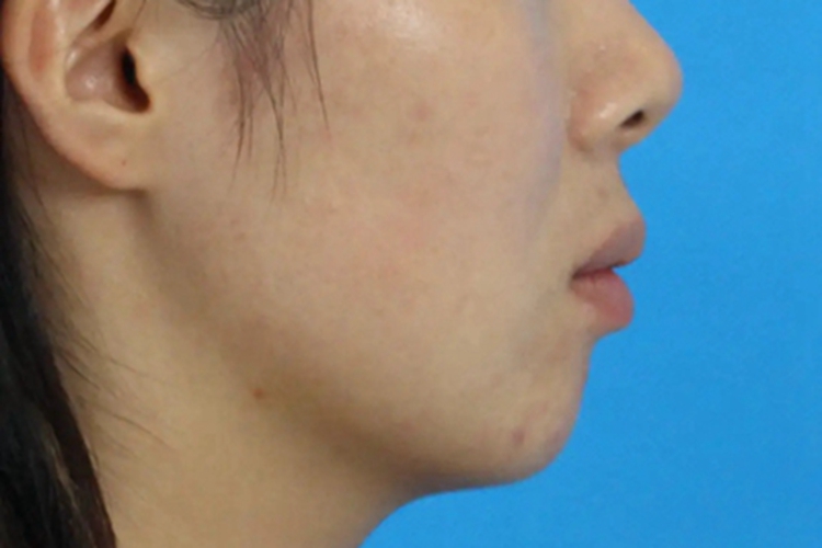 深覆(牙合)嘴唇前突图 深覆(牙合)嘴唇前突图