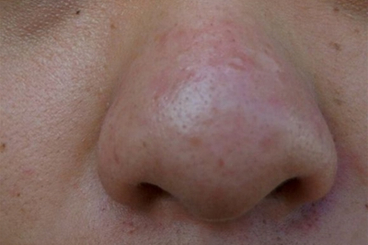 红斑毛细血管扩张型酒糟鼻丘疹图