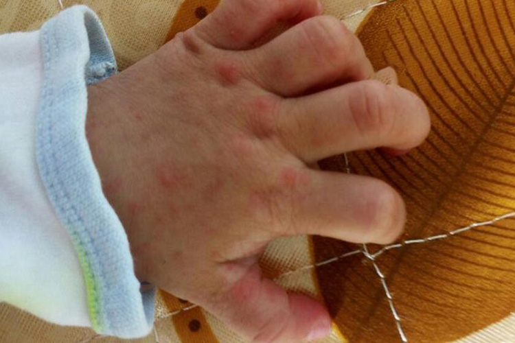 手足口病初期手部皮疹图