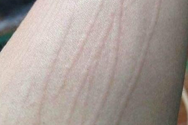 人工荨麻疹大腿上有条状凸起图