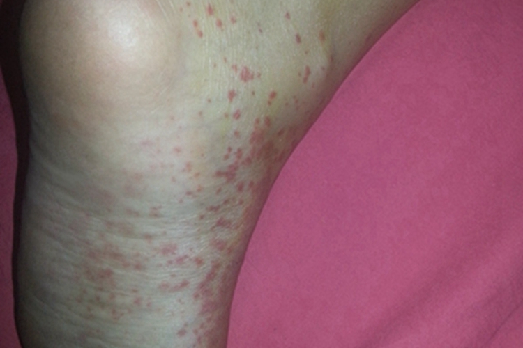 小儿过敏性紫癜脚部症状图 小儿过敏性紫癜脚部症状图