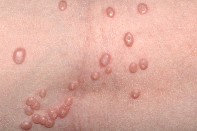 传染性软疣的丘疹图