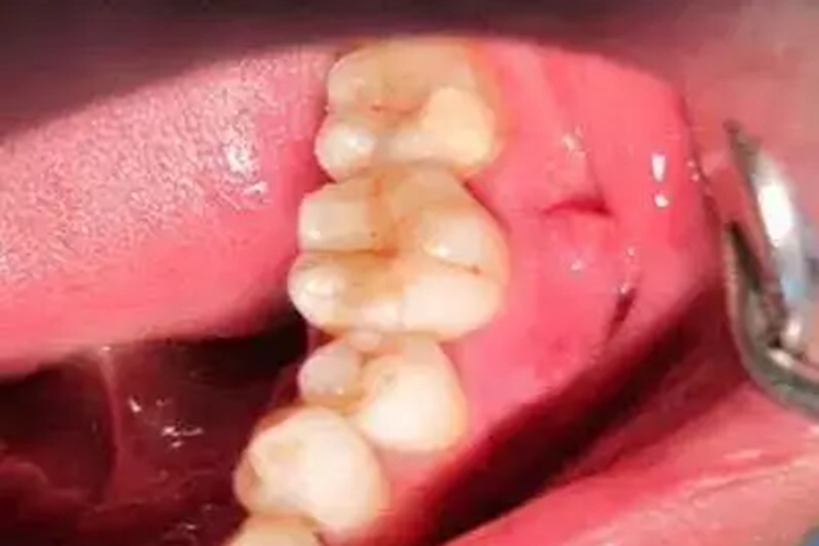 牙隐裂早期图片 牙隐裂早期图片