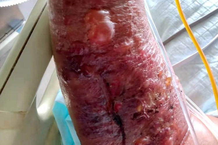 手臂皮肤炭疽病图片