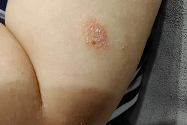 钱币状湿疹胳膊症状图