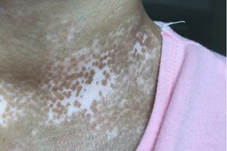 稳定期节段型白癜风白斑图 稳定期节段型白癜风白斑图