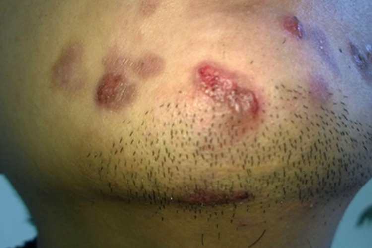 卡波西水痘样疹下巴水疱图