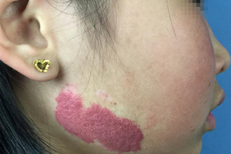 鲜红斑痣面部红色斑块图 鲜红斑痣面部红色斑块图