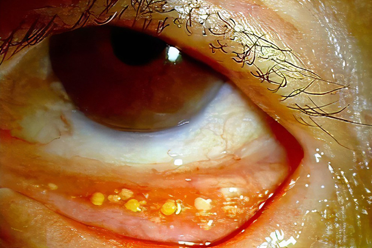 下眼睑结石图片