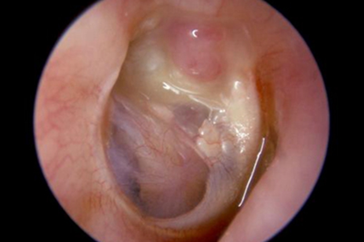 急性中耳炎症状图
