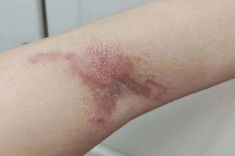 隐翅虫皮炎晚期色素沉着图