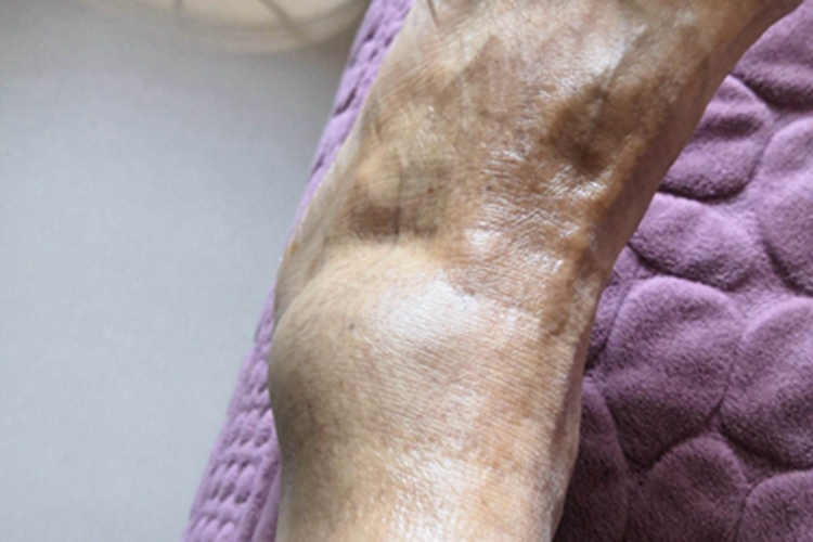 踝扭伤脚踝鼓起大包图