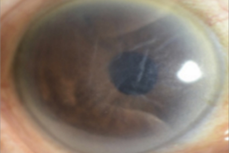 大泡性角膜病变眼球发白图