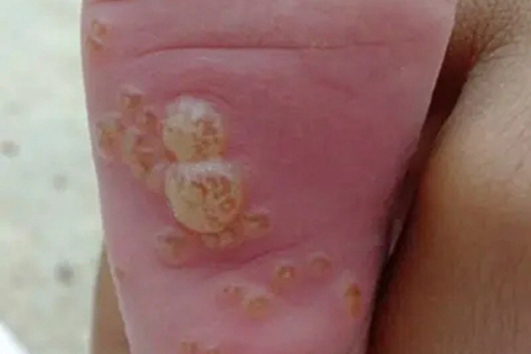 药物过敏性口炎脚底症状图