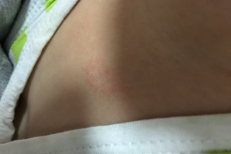 小孩腹部体癣图