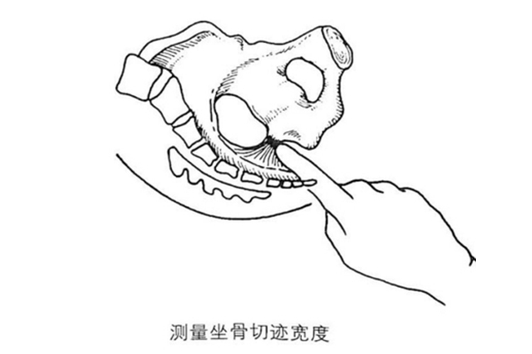 坐骨切迹宽度测量图
