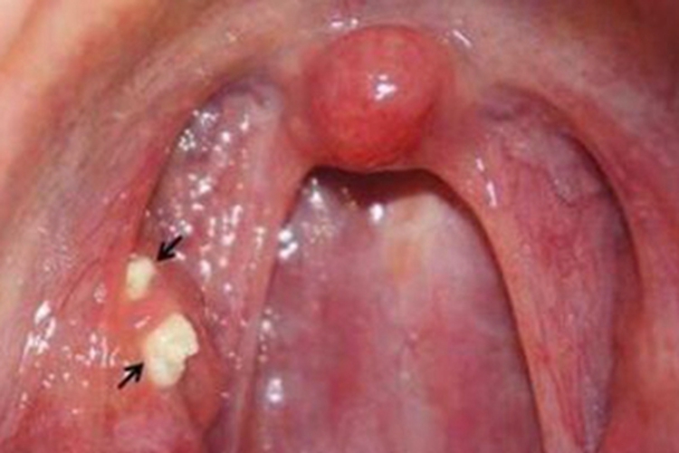 慢性扁桃体炎白点图