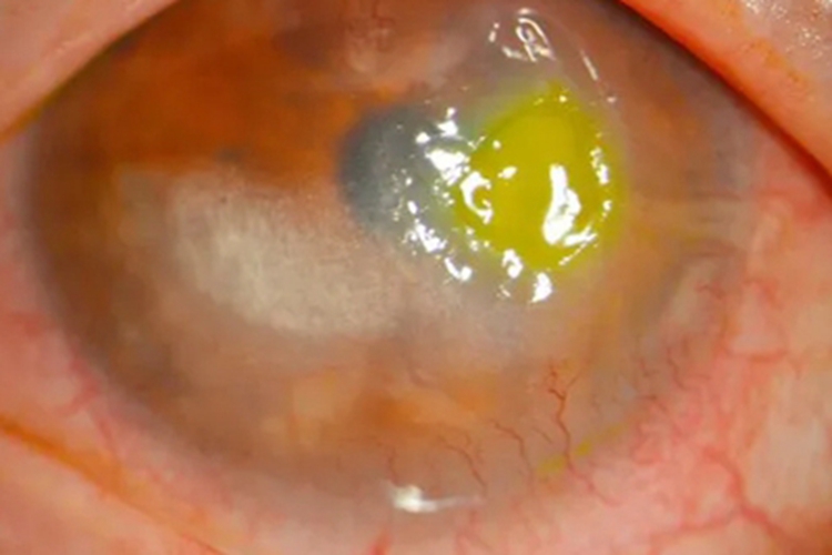 角膜挫伤角膜溃疡图 角膜挫伤角膜溃疡图