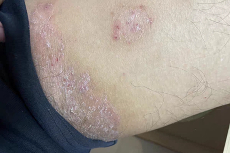 股癣大腿根有红斑脱皮图