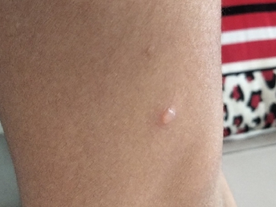 水痘大腿上长了一个透明的小水疱图