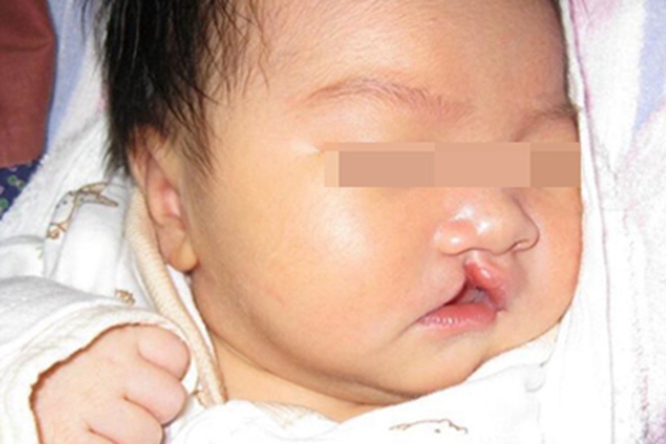 狭颅症裂口图