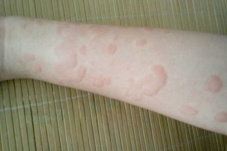 宝宝冷接触性荨麻疹风团图