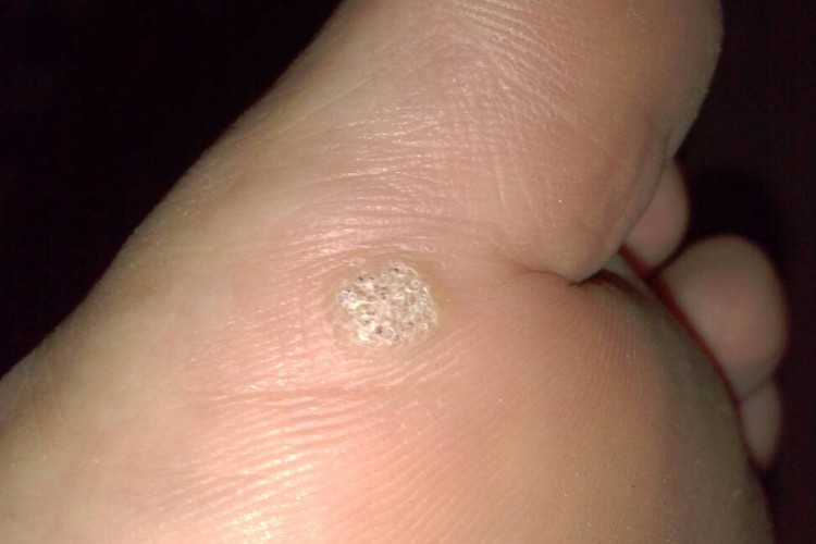 硬鸡眼皮肤增厚图