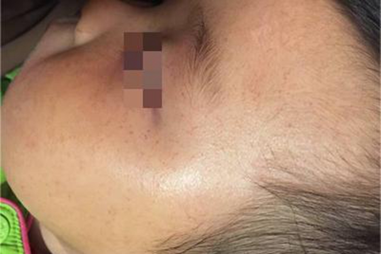 机械性紫癜脸上有血点图 机械性紫癜脸上有血点图