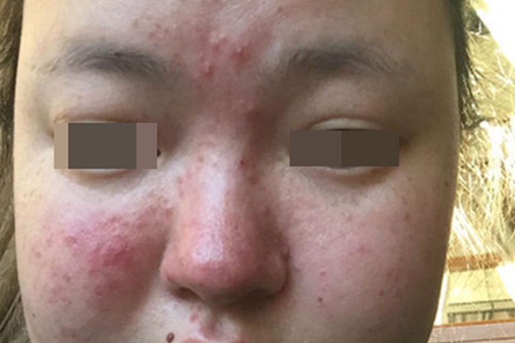 丘疹脓疱型酒糟鼻面部症状图 丘疹脓疱型酒糟鼻面部症状图