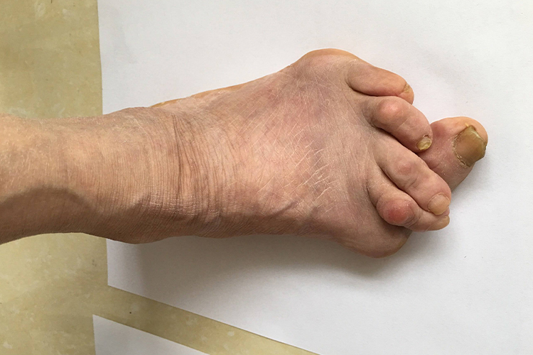 类风湿关节炎脚趾变形图