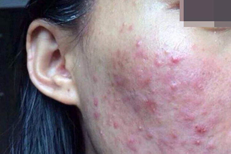聚合性痤疮面部丘疹图