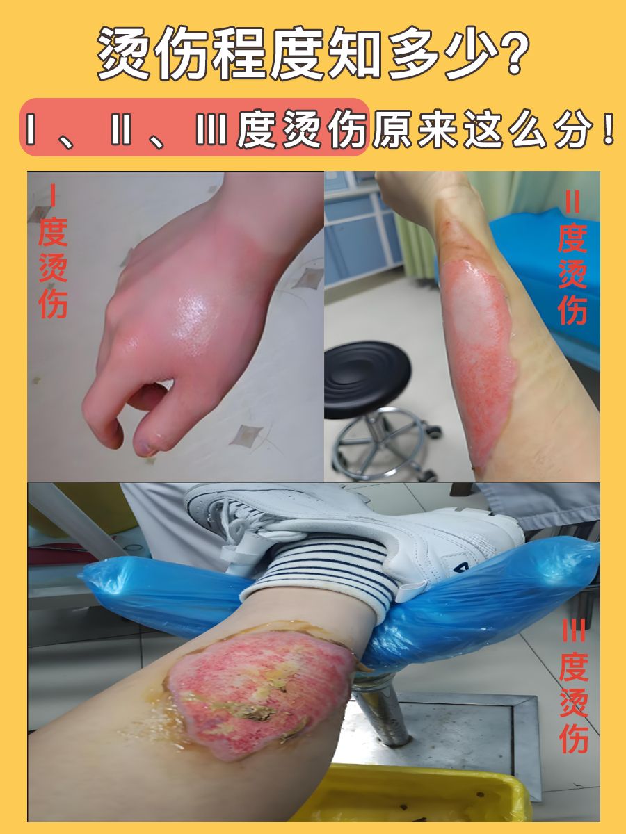 烫伤程度知多少？Ⅰ、Ⅱ、Ⅲ度烫伤原来这么分！