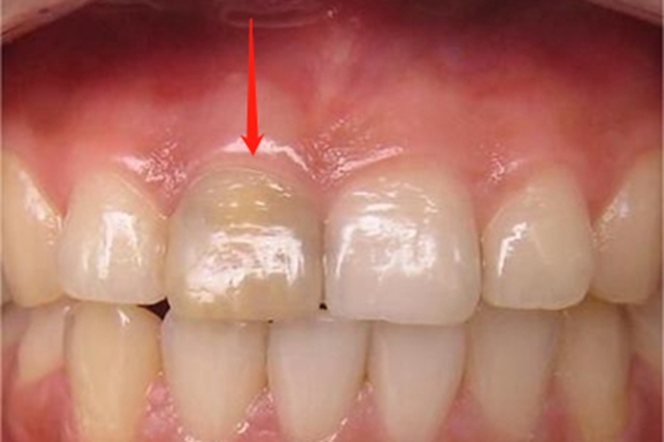 死髓牙发黄图 死髓牙发黄图