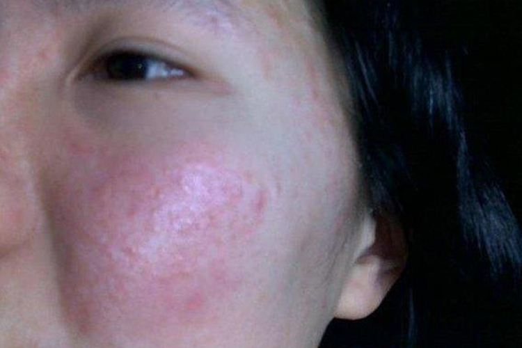 轻度化妆品过敏图 轻度化妆品过敏图