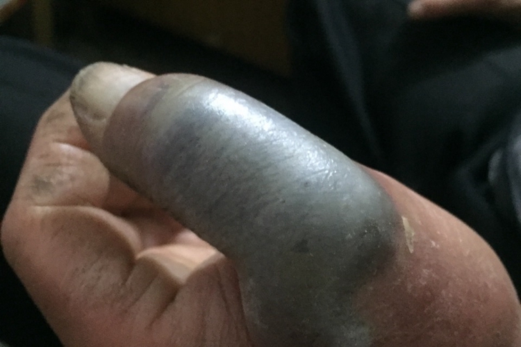 大拇指皮下血肿图